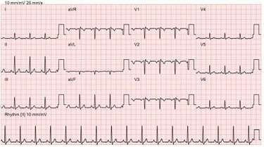 典型的心电图波形